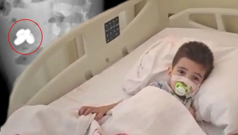 Pil ve Mıknatıs Yutan Çocuğun Bağırsaklarının Yanmasına Dikkat!