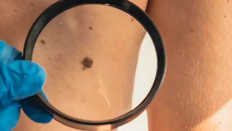 26 Yaşında Kanser Teşhisi: Hayatını Değiştiren Benler